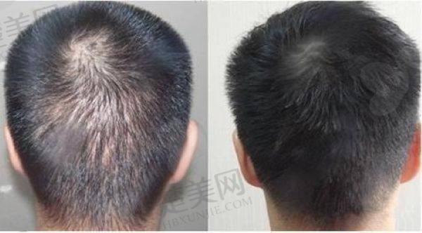 植发价格表一览表2025
