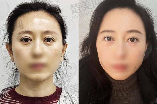 杜圆圆修复双眼皮多少钱