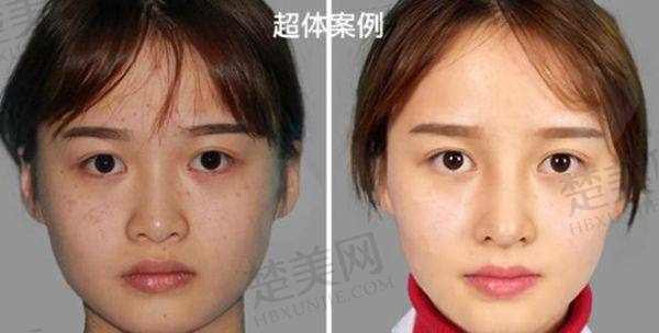 北京刘彦军 医生做鼻子多少钱