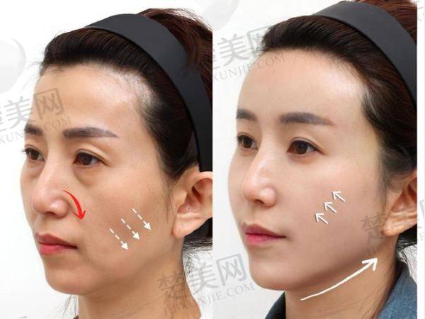 成都素美李建钢无痕筋膜提升怎么样
