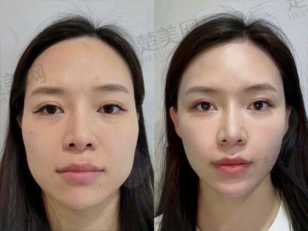 成都素美李建钢无痕筋膜提升多少钱