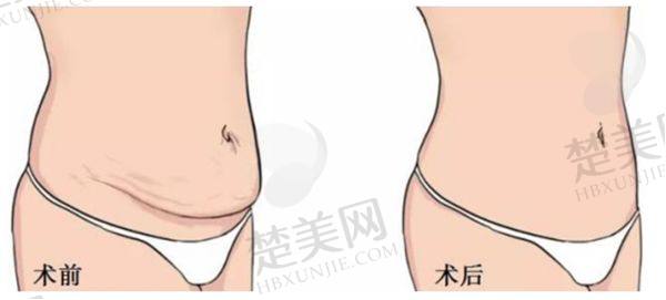 顾建成医生吸脂怎么样