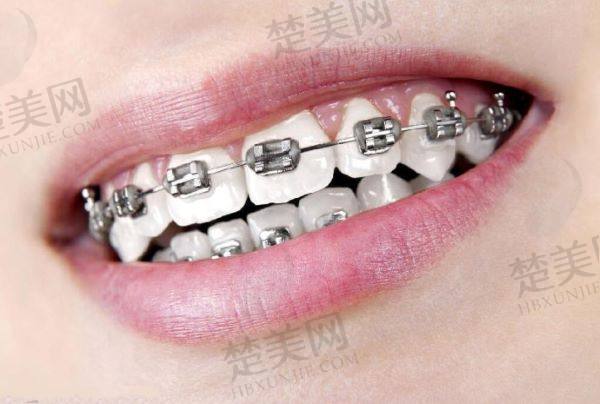 无锡牙齿矫正医院哪家好
