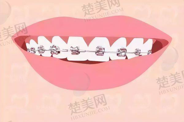 无锡牙齿矫正多少钱
