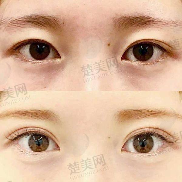 沈阳名流双眼皮哪个医生做的好