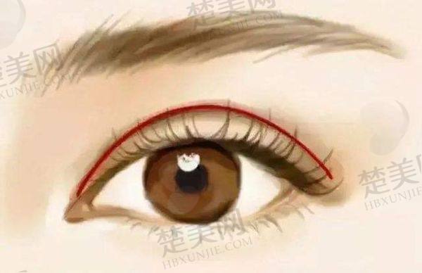 北京魏志香双眼皮修复价格表