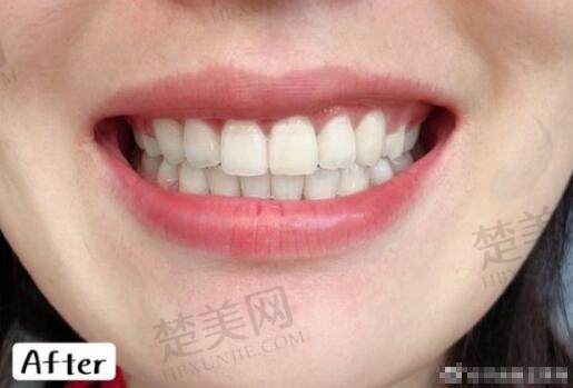 北京赛德阳光口腔牙齿矫正病例分享