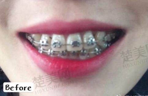 北京赛德阳光口腔牙齿矫正病例分享