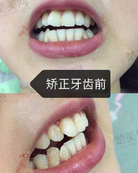 维乐口腔医院牙齿矫正病例分享