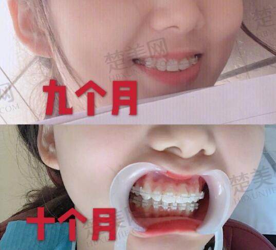 维乐口腔医院牙齿矫正病例分享