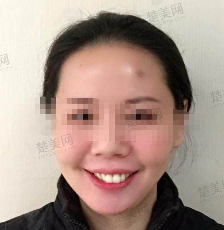 成都口碑好不好？王晓霞医生口腔矫正4个月恢复图反馈