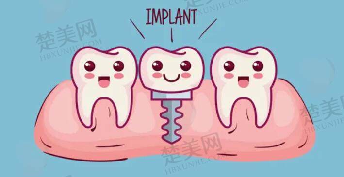牙齿种植动漫49.jpg