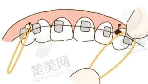 牙齿矫正动漫36.jpg