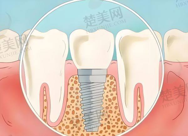 北海做种植牙医院哪家好一点？这些口碑佳、技术强的医院值得你深入了解！