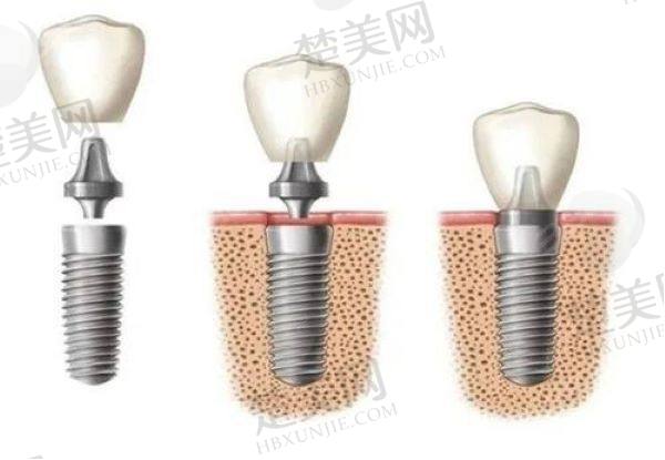 长沙伊乐美口腔做种植义牙怎么样?专业团队技术优,患者满意度超高值得选择!