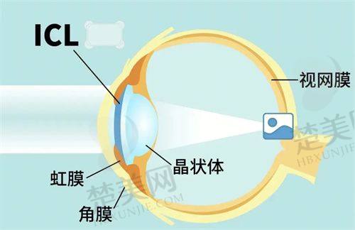 六、贵阳康视眼科医院价格表