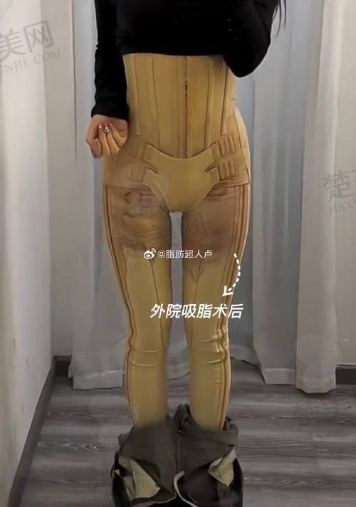 杭州彭涛医生属于哪家医美医院？吸脂技术好价格优预约方式全揭秘