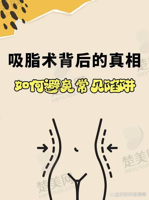 二、杭州彭涛医生的吸脂技术如何