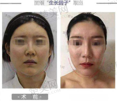 成都星范医疗美容整形门诊隆鼻技术分析