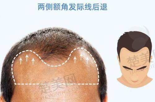 三、吴贞跃医生馒化脸修复成功实例