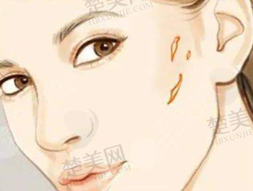 三、西 京医院微整形丰下巴实例