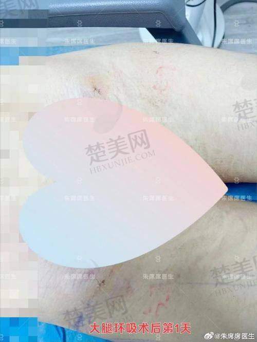 四、余恩旭做吸脂瘦脸的隐藏价值
