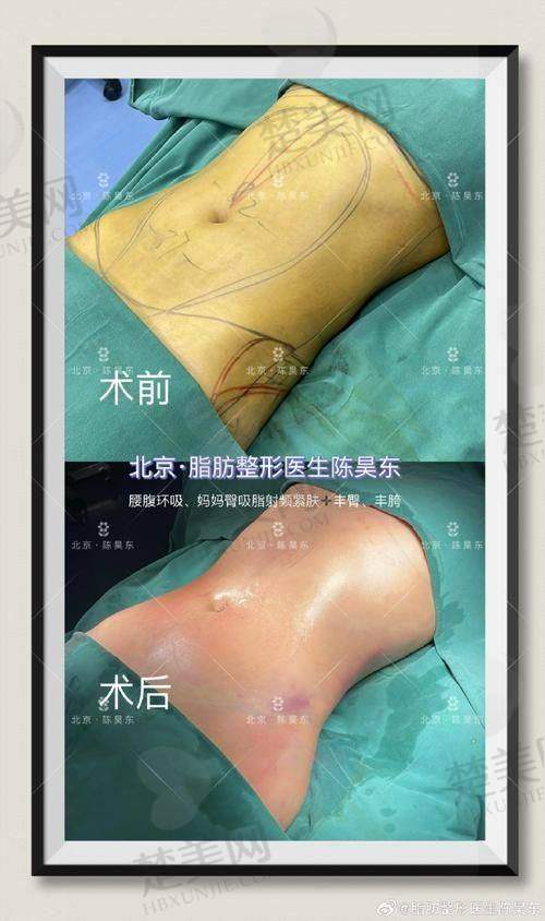 三、黄金微雕与光纤溶脂的成效差异对比