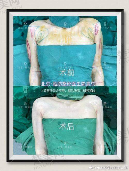 三、赵希军吸脂技术亮点解析