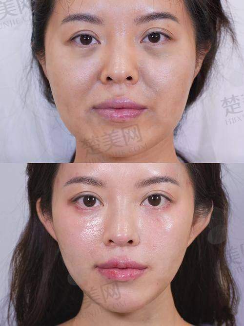 五、王阔远医生治疗“馒化脸”的优势