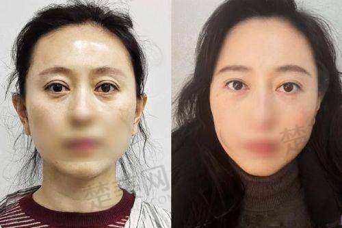 三、合肥吴丽丽医生做双眼皮的成功实例