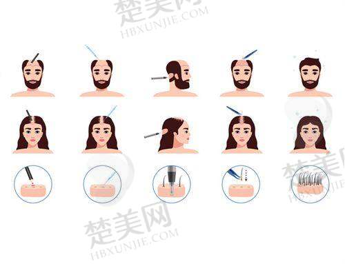 三、广东崇爱植发医院人气医生介绍