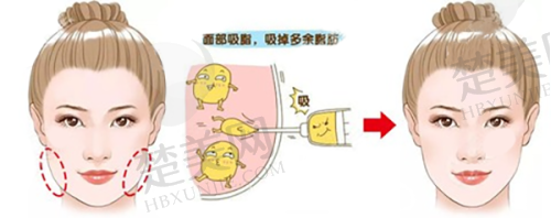 三、合肥艺星假体隆胸项目收费详情