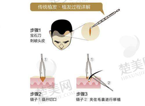 四、北京碧莲盛植发的服务与价格体系