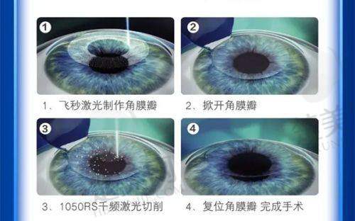 四、北京同仁眼科医院费用一键查询