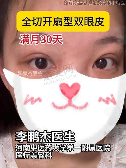五、合肥吴丽丽医生做双眼皮的术前术后注意事项