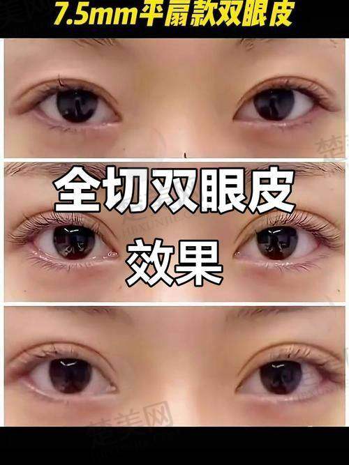 二、合肥吴丽丽医生做双眼皮的技术特点