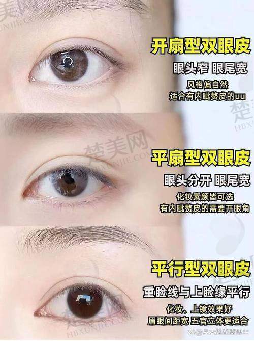 三、擅长修复各类失败双眼皮
