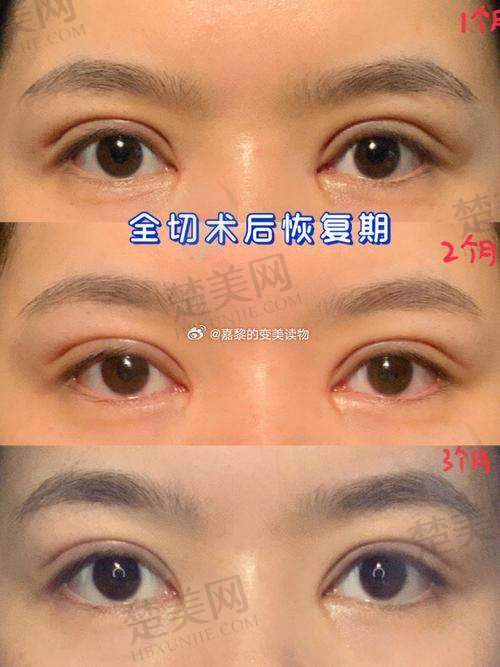 三、切开重睑术：美眼的“魔法钥匙”