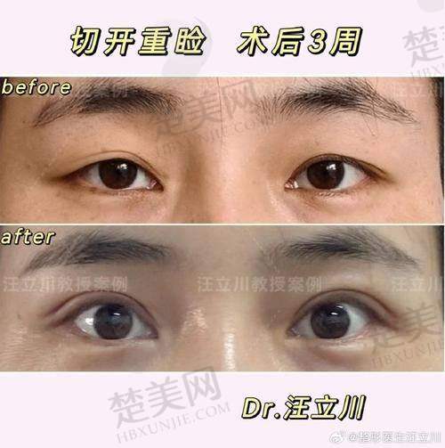 六、合肥吴丽丽医生做双眼皮的口碑与评价