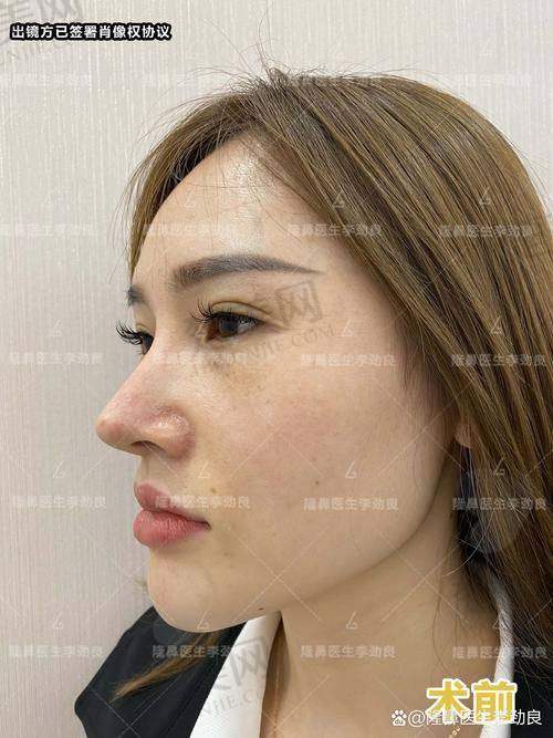 一、杭州艺星医院隆鼻实力