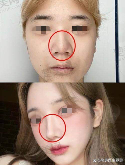三、李建兵医生隆鼻手术安心性保护