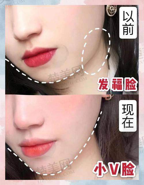 一、瘦脸注射的原理与适用人群