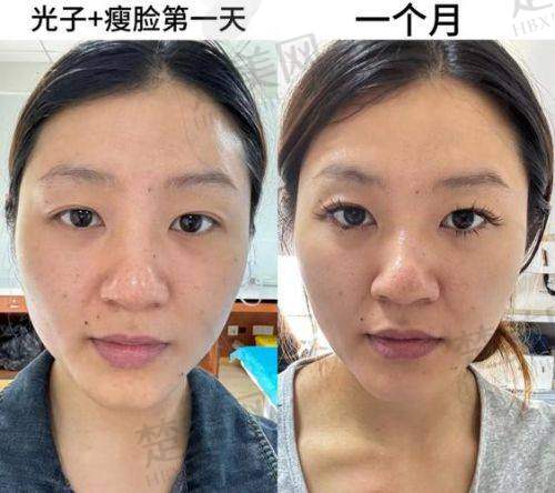 四、瘦脸注射的风险