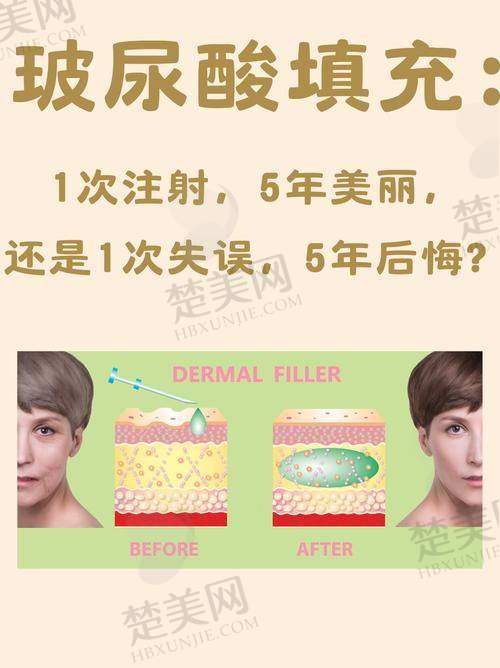 三、苹果肌填充的其他注意事项