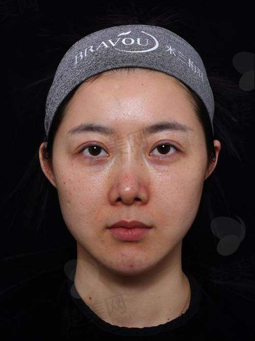 二、不同场景下“玻尿酸多少一针”的具体情况