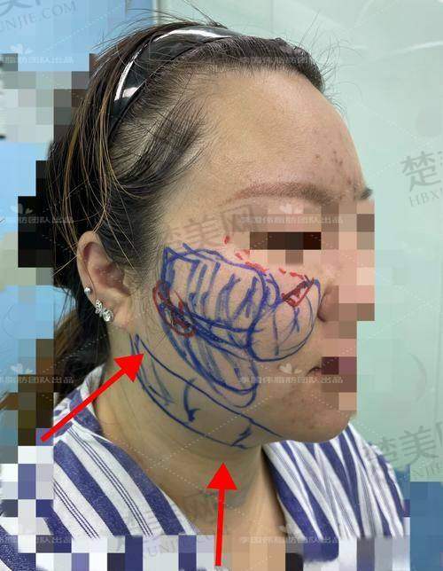 二、影响面部填充价格的因素