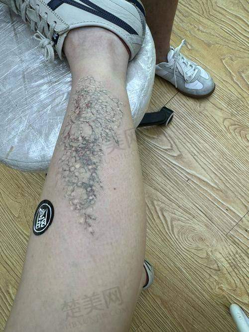 五、邯郸中医医院整形外科：正规科室的洗纹身保护