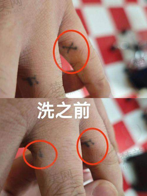 四、邯郸雅丽医疗美容门诊部：微创理念下的洗纹身特色