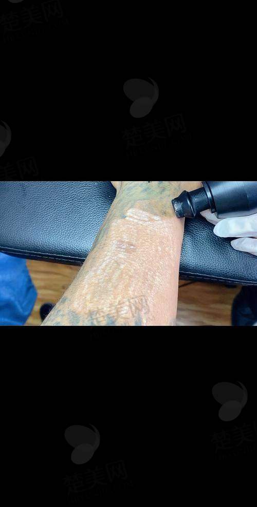 六、邯郸市第三医院整形美容科：多年沉淀的洗纹身技艺