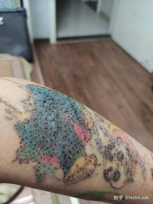 三、邯郸京美医疗整形美容医院：老牌医院的洗纹身实力
